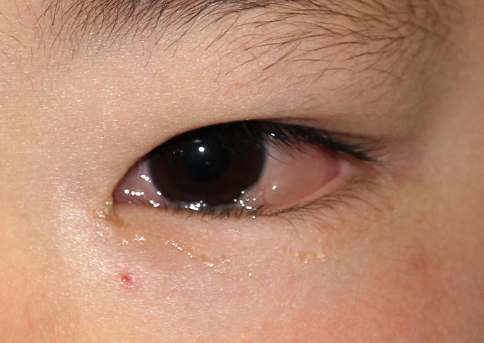 目 が で 腫れる 花粉 どうして花粉症になると、まぶたが腫れるのか？その２つの原因｜花粉症の症状
